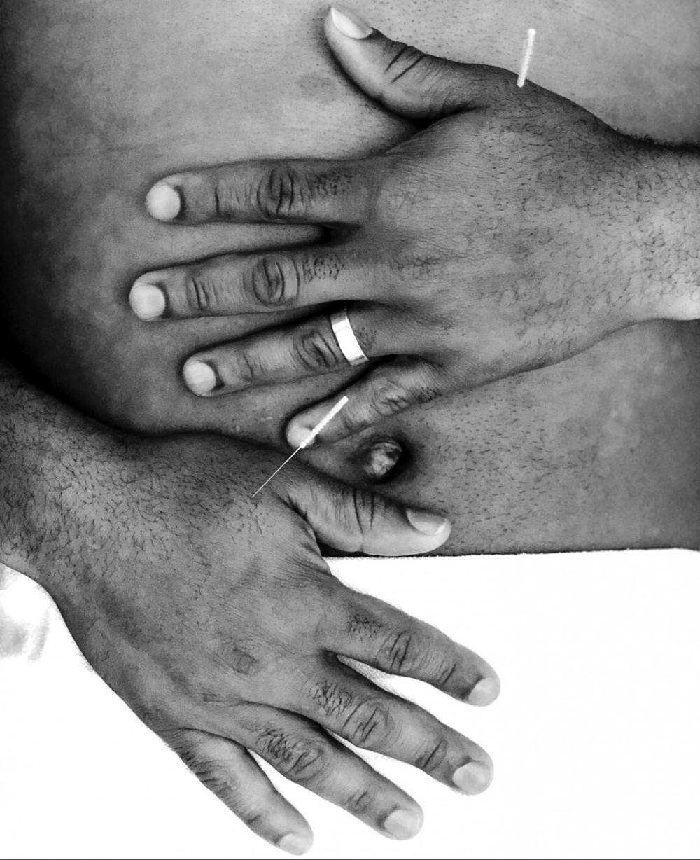 grayscale photo of acupuncture needles in a mans hands